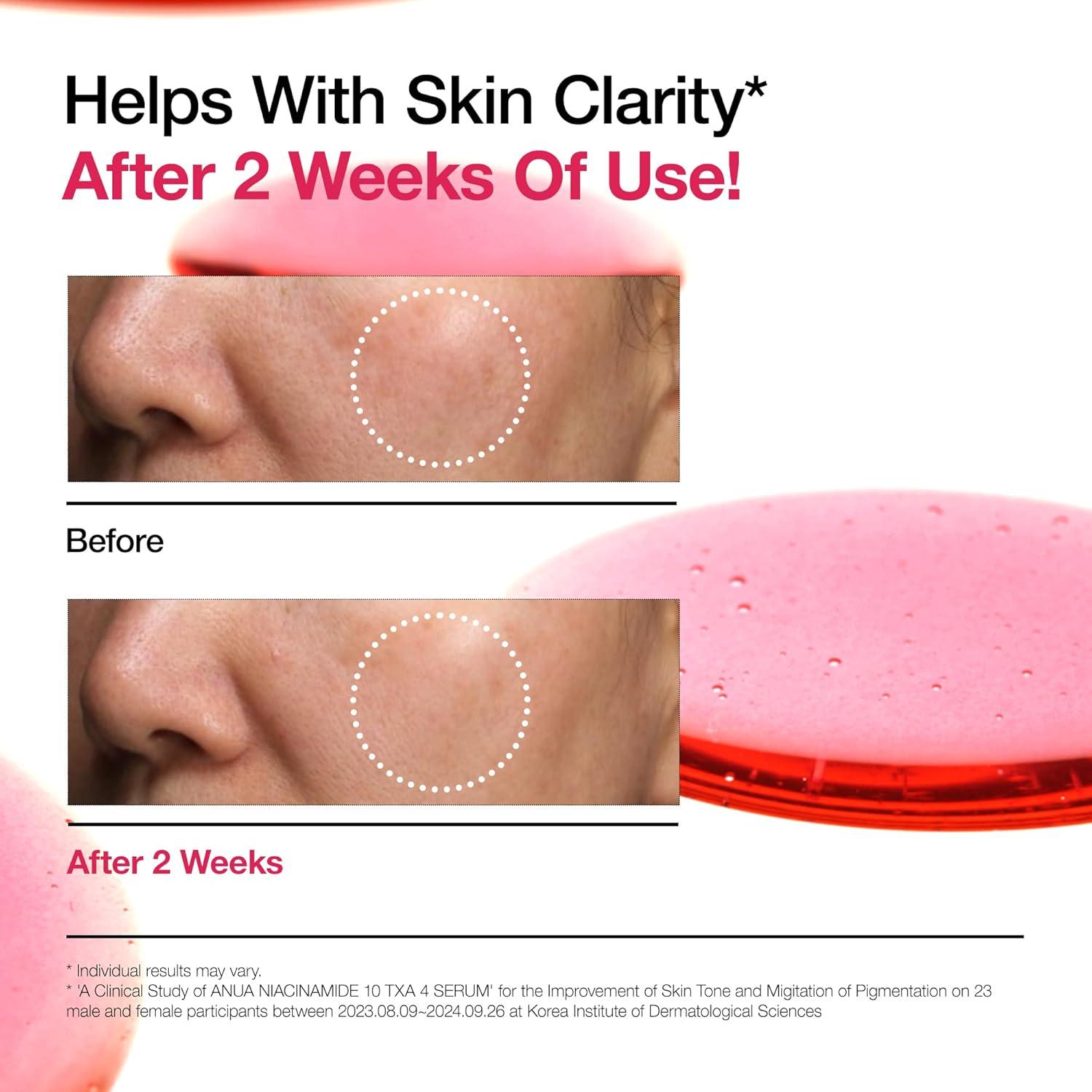 image:imageAnua Ultimate Spot Duo Niacinamide 10 TXA 4 Serum amp Azelaic Acid 10 Hyaluron Redness Soothing Serum Early amp Post Spot Care Skin Clarifying Natural Color Korean Skincare Set